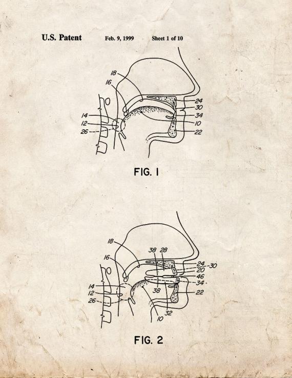 Dental Appliance for Treatment Of Snoring and Obstructive Sleep Apnea Patent Print